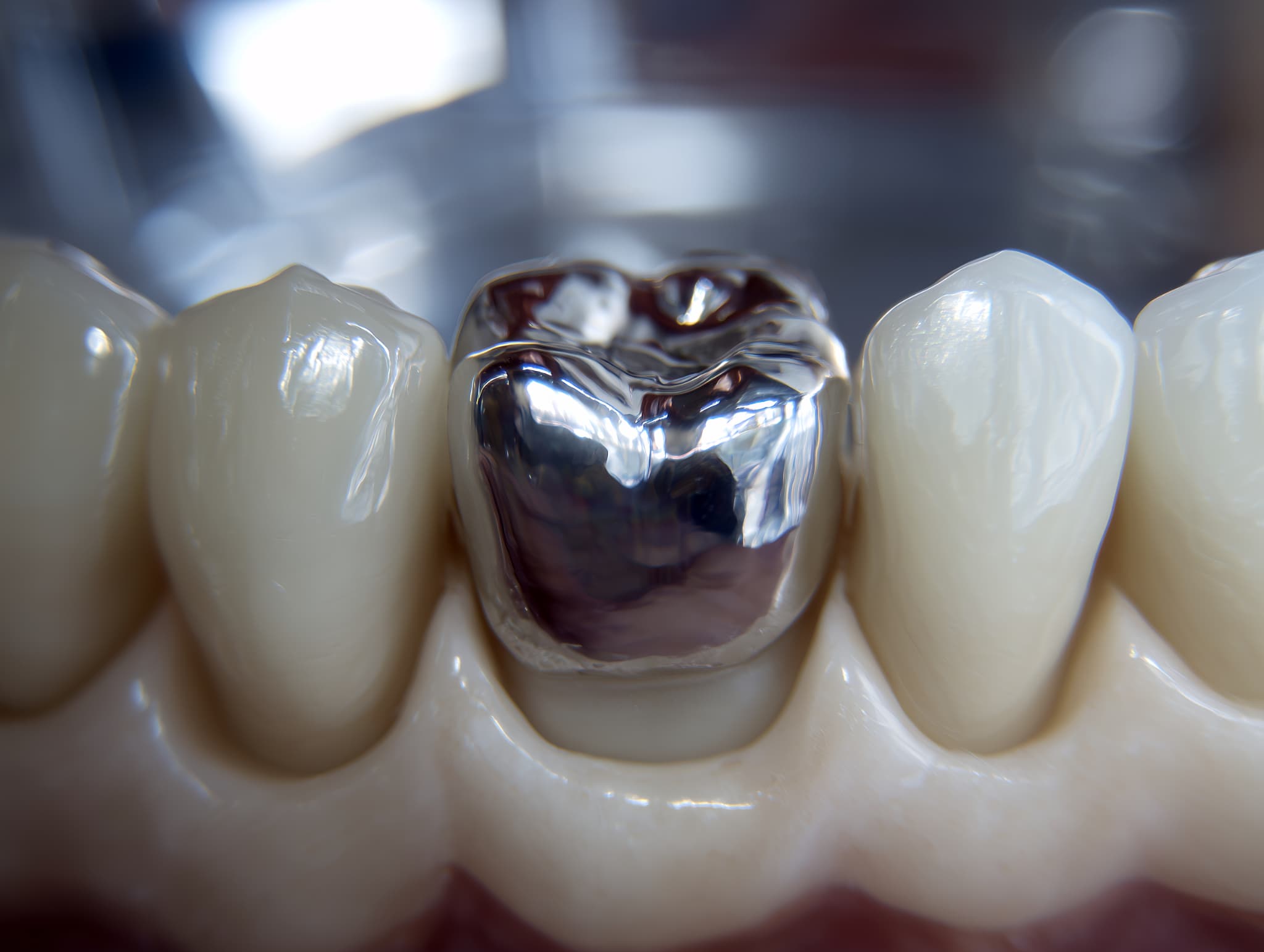 銀歯は大丈夫？  世界基準から考察